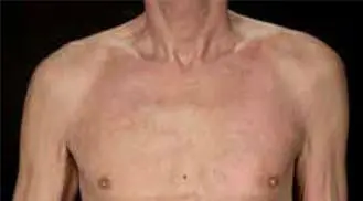 ALHYDRAN-Case-Study-10-Scald-hot-water-explosion-After