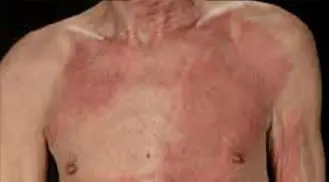 ALHYDRAN-Case-Study-10-Scald-hot-water-explosion-Before